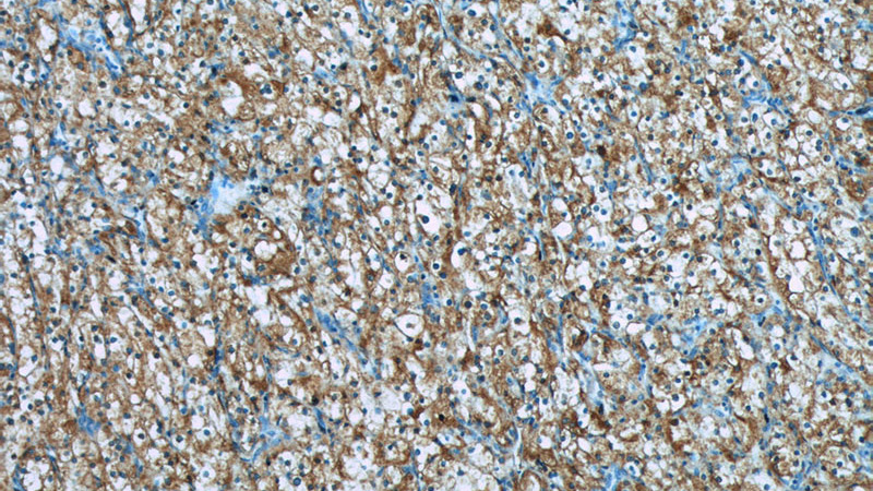 Immunohistochemistry of paraffin-embedded human renal cell carcinoma tissue slide using Catalog No:117200(BMP7 Antibody) at dilution of 1:50 (under 10x lens)