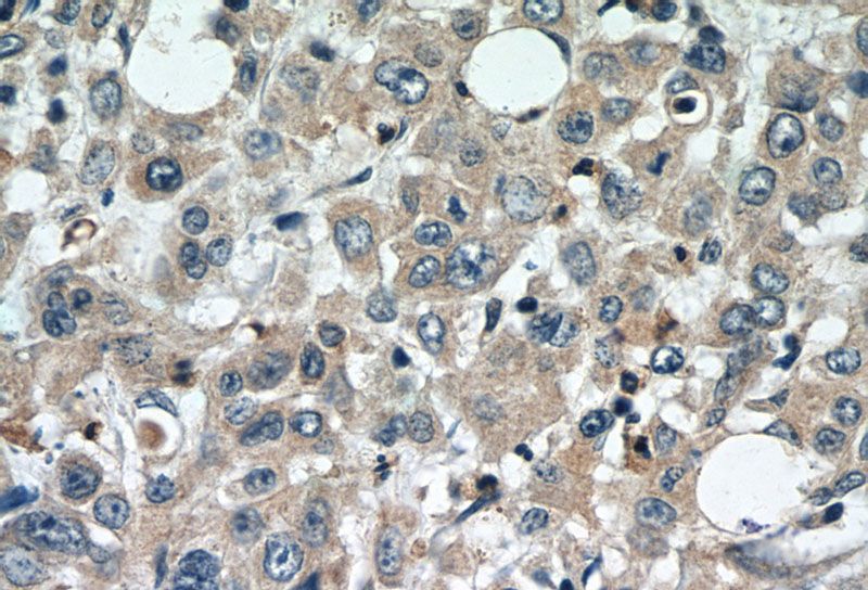 Immunohistochemistry of paraffin-embedded human stomach cancer tissue slide using Catalog No:109885(DEFB121 Antibody) at dilution of 1:50 (under 40x lens)