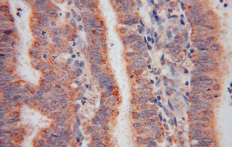 Immunohistochemical of paraffin-embedded human endometrial cancer using Catalog No:116459(TXNRD2 antibody) at dilution of 1:50 (under 40x lens)