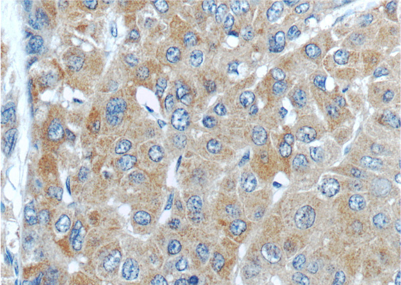 Immunohistochemistry of paraffin-embedded human liver cancer tissue slide using Catalog No:113786(PGLYRP2 Antibody) at dilution of 1:50 (under 40x lens)