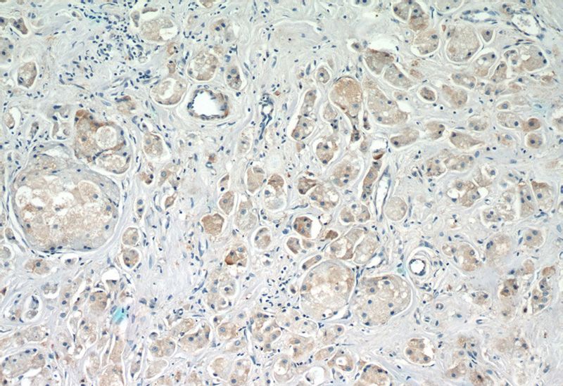 Immunohistochemistry of paraffin-embedded human breast cancer slide using Catalog No:108244(ARF3 Antibody) at dilution of 1:50 (under 10x lens)