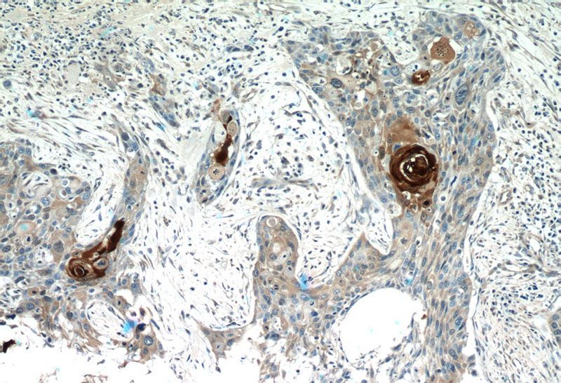 Immunohistochemistry of paraffin-embedded human oesophagus cancer tissue slide using Catalog No:114964(S100A7 Antibody) at dilution of 1:50 (under 10x lens)