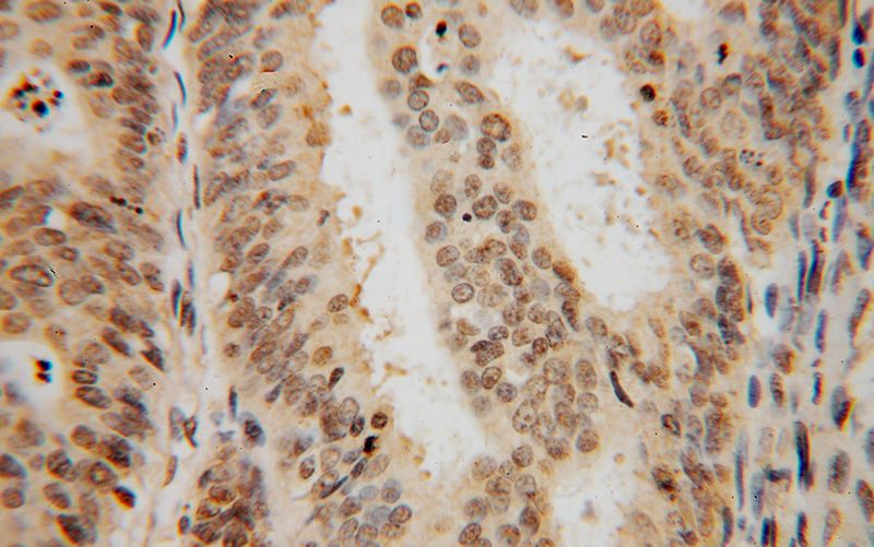 Immunohistochemical of paraffin-embedded human endometrial cancer using Catalog No:115134(SF3A2 antibody) at dilution of 1:50 (under 40x lens)