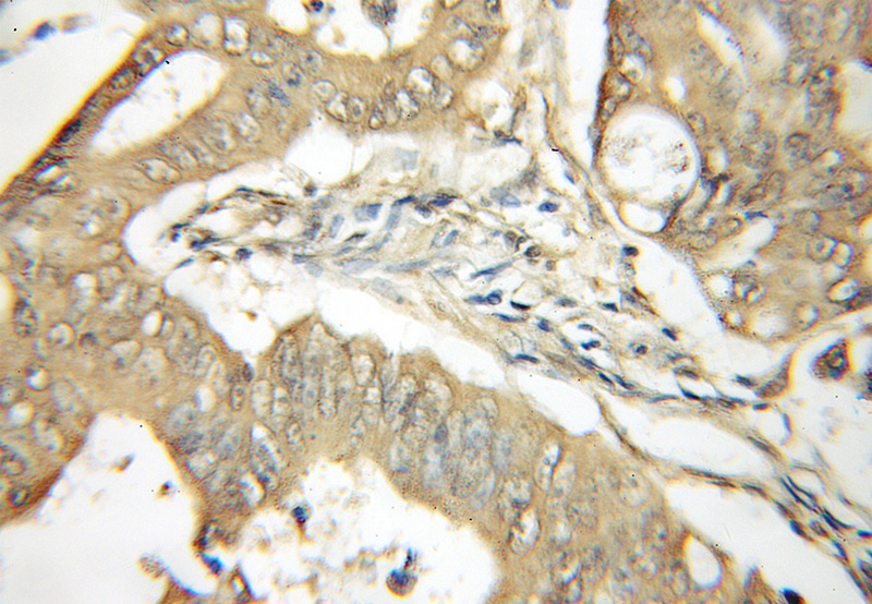 Immunohistochemical of paraffin-embedded human colon cancer using Catalog No:116887(YME1L1 antibody) at dilution of 1:50 (under 10x lens)