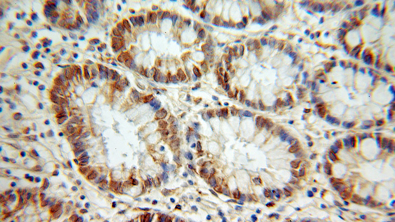 Immunohistochemical of paraffin-embedded human colon cancer using Catalog No:114336(PUF60 antibody) at dilution of 1:100 (under 10x lens)
