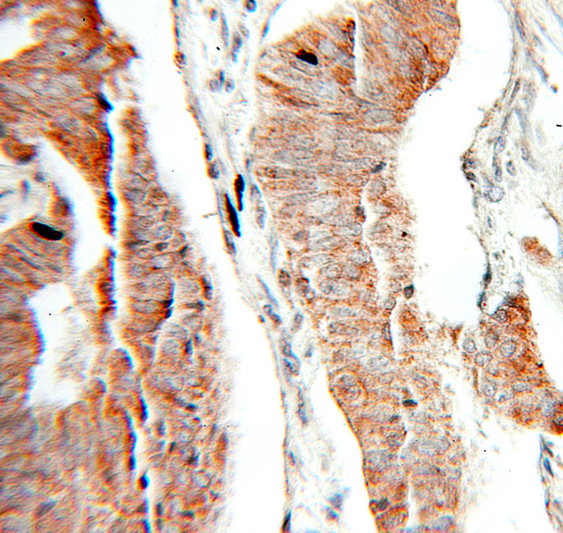 Immunohistochemical of paraffin-embedded human pancreas cancer using Catalog No:114006(PLOD3 antibody) at dilution of 1:50 (under 10x lens)