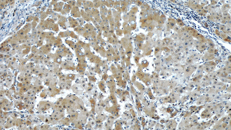 Immunohistochemical of paraffin-embedded human hepatocirrhosis using Catalog No:107403(IL7 antibody) at dilution of 1:50 (under 10x lens)