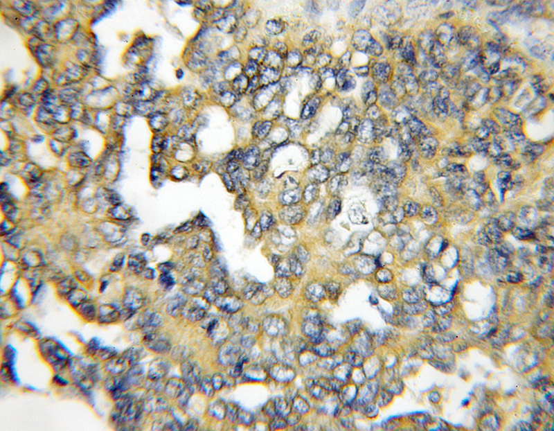 Immunohistochemical of paraffin-embedded human ovary tumor using Catalog No:114483(RASSF6 antibody) at dilution of 1:100 (under 10x lens)