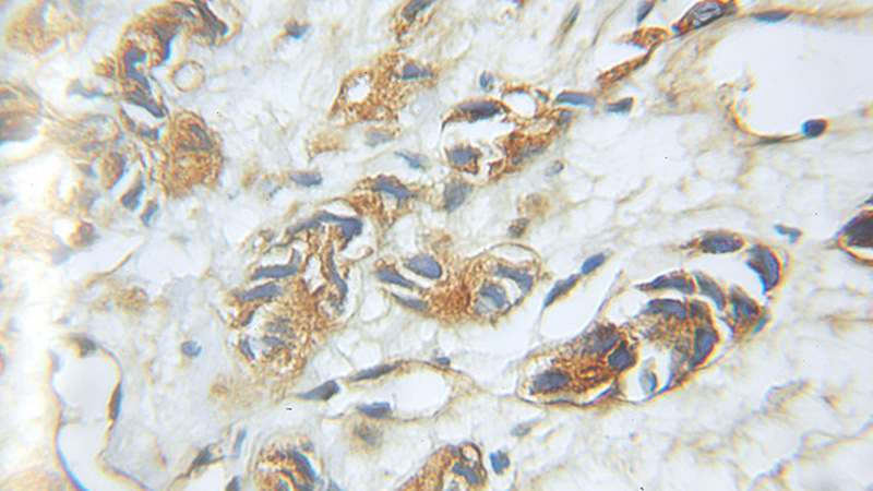 Immunohistochemical of paraffin-embedded human prostate cancer using Catalog No:114243(PSMD5 antibody) at dilution of 1:100 (under 10x lens)