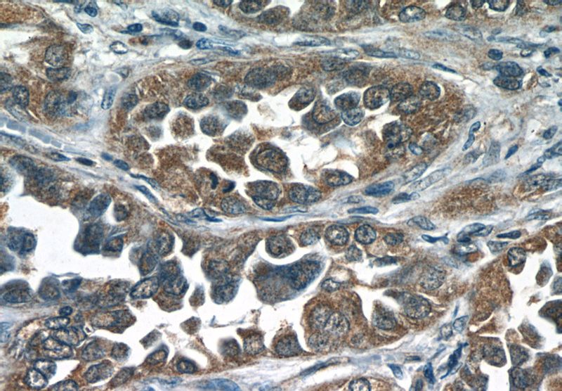 Immunohistochemistry of paraffin-embedded human lung cancer tissue slide using Catalog No:113042(NCOA3 Antibody) at dilution of 1:50
