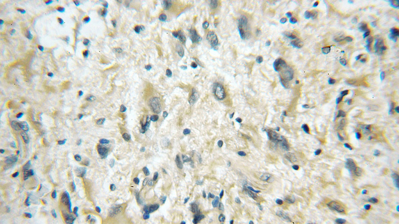 Immunohistochemical of paraffin-embedded human gliomas using Catalog No:110557(FBXO6 antibody) at dilution of 1:50 (under 10x lens)