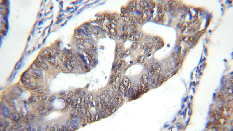 Immunohistochemical of paraffin-embedded human colon cancer using Catalog No:109770(DDB1 antibody) at dilution of 1:50 (under 10x lens)