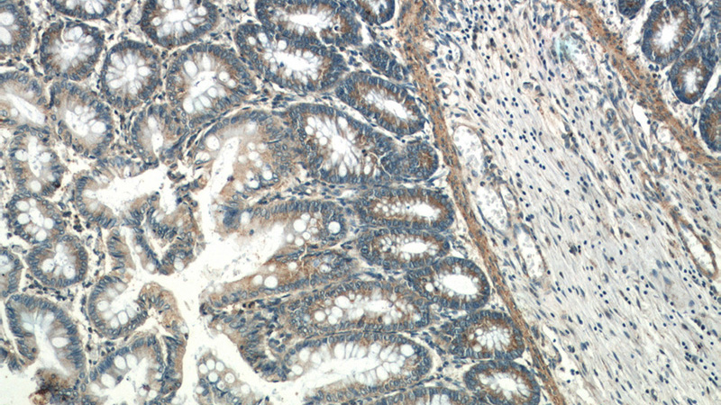Immunohistochemistry of paraffin-embedded human colon slide using Catalog No:116527(UBE2H Antibody) at dilution of 1:50