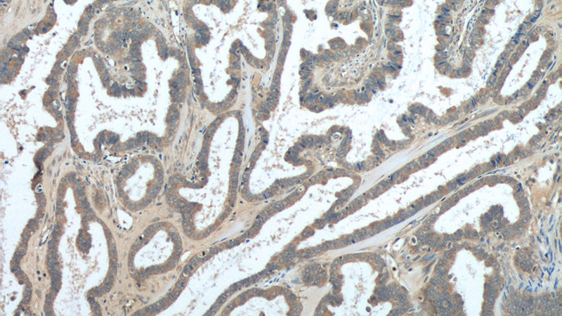 Immunohistochemistry of paraffin-embedded human ovary tumor tissue slide using Catalog No:116197(TMEM77 Antibody) at dilution of 1:50 (under 10x lens)