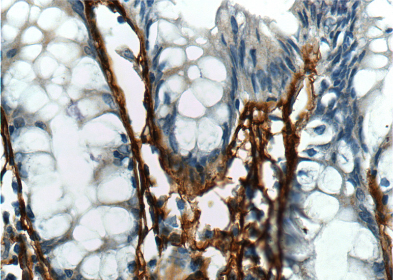 Immunohistochemistry of paraffin-embedded human colon tissue slide using Catalog No:113715(POSTN Antibody) at dilution of 1:200 (under 40x lens).