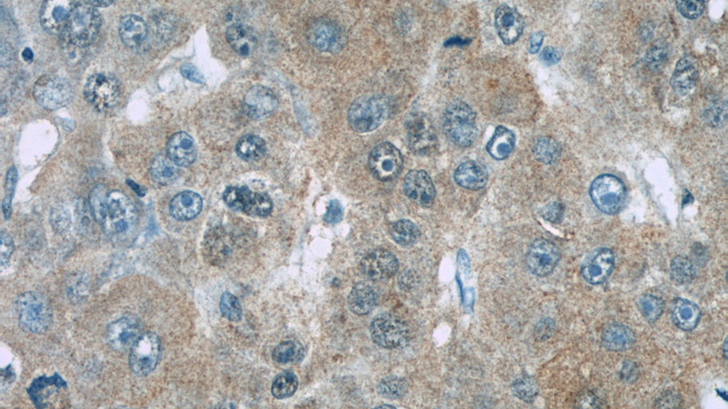 Immunohistochemistry of paraffin-embedded human liver cancer slide using Catalog No:107287(CSE Antibody) at dilution of 1:50