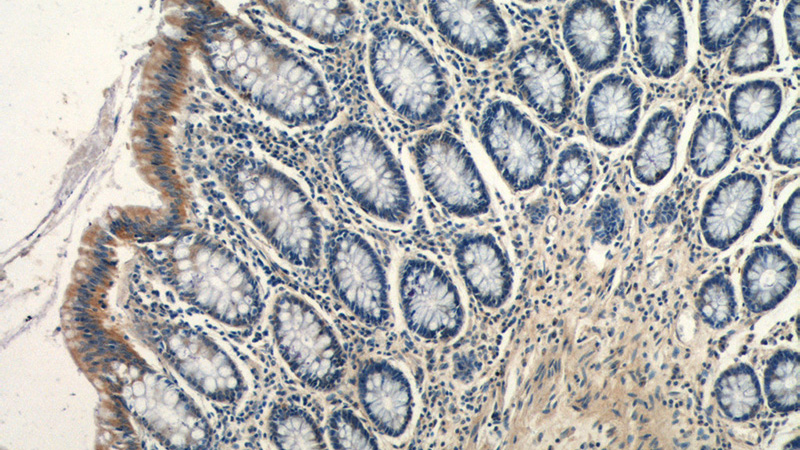 Immunohistochemistry of paraffin-embedded human colon tissue slide using Catalog No:111954(ITM2C Antibody) at dilution of 1:50 (under 10x lens)
