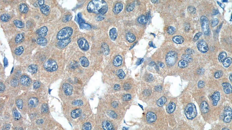 Immunohistochemistry of paraffin-embedded human liver cancer tissue slide using Catalog No:111781(IL27 Antibody) at dilution of 1:50 (under 40x lens)