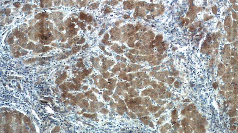Immunohistochemistry of paraffin-embedded human hepatocirrhosis tissue slide using Catalog No:108053(AGT Antibody) at dilution of 1:50 (under 10x lens)