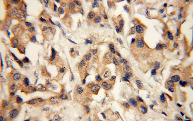 Immunohistochemical of paraffin-embedded human breast cancer using Catalog No:115262(SH3PXD2A antibody) at dilution of 1:50 (under 40x lens)