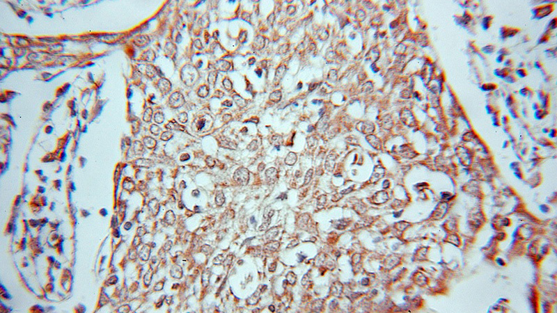 Immunohistochemical of paraffin-embedded human cervical cancer using Catalog No:115277(SHMT2 antibody) at dilution of 1:50 (under 10x lens)
