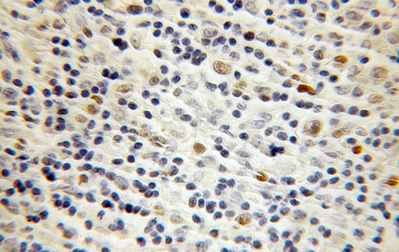 Immunohistochemical of paraffin-embedded human lymphoma using Catalog No:113470(POU2F2 antibody) at dilution of 1:100 (under 10x lens)