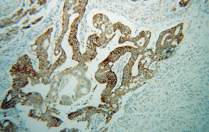 Immunohistochemical of paraffin-embedded human colon cancer using Catalog No:115820(SUCLG2 antibody) at dilution of 1:100 (under 10x lens)