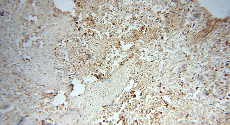 Immunohistochemical of paraffin-embedded human lung cancer using Catalog No:110374(PDIA3 antibody) at dilution of 1:100 (under 10x lens)