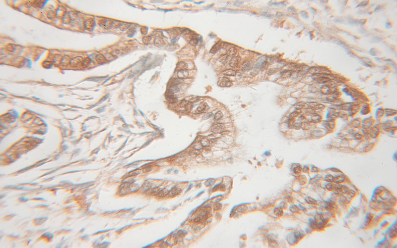 Immunohistochemical of paraffin-embedded human pancreas cancer using Catalog No:116569(CMPK1 antibody) at dilution of 1:100 (under 10x lens)