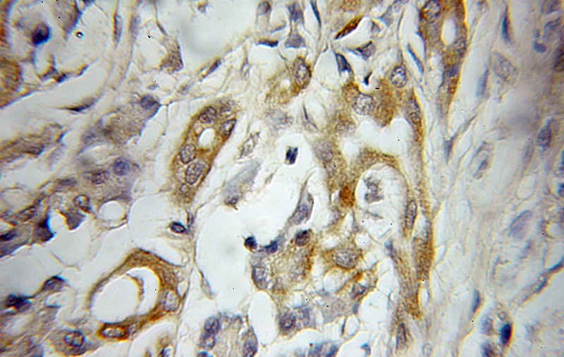 Immunohistochemical of paraffin-embedded human pancreas cancer using Catalog No:108118(AP1M2 antibody) at dilution of 1:10 (under 10x lens)