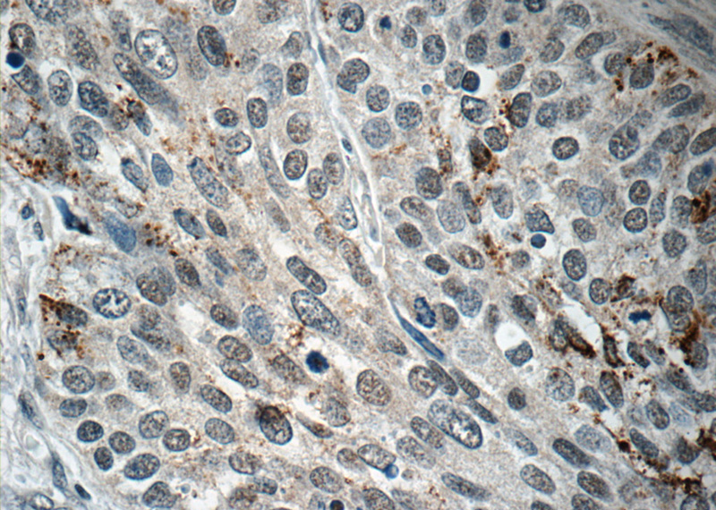 Immunohistochemistry of paraffin-embedded human cervical cancer tissue slide using Catalog No:117229(BRD7 Antibody) at dilution of 1:50 (under 40x lens)