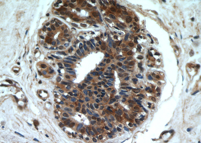 Immunohistochemical of paraffin-embedded human breast cancer using Catalog No:110776(FRK antibody) at dilution of 1:50 (under 40x lens)