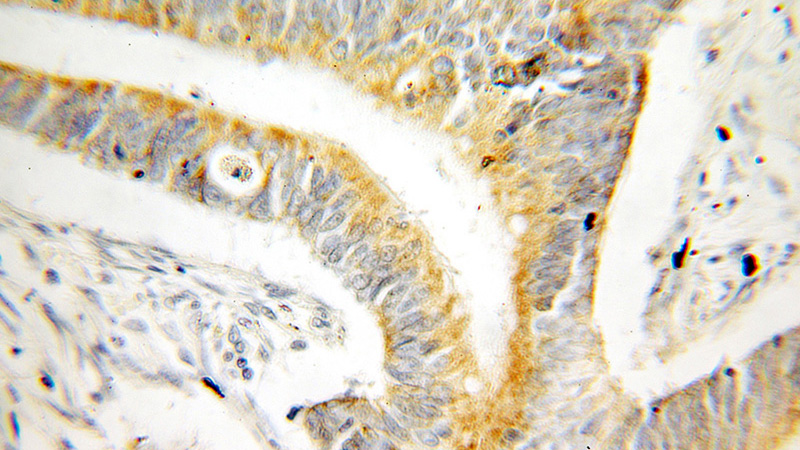Immunohistochemical of paraffin-embedded human colon cancer using Catalog No:110116(DUSP13 antibody) at dilution of 1:100 (under 25x lens)