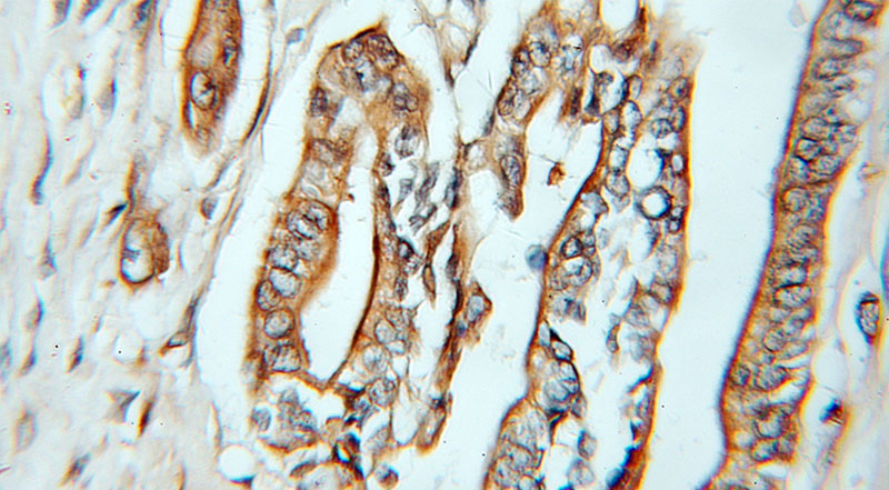 Immunohistochemical of paraffin-embedded human pancreas cancer using Catalog No:108877(CASP4 antibody) at dilution of 1:50 (under 25x lens)