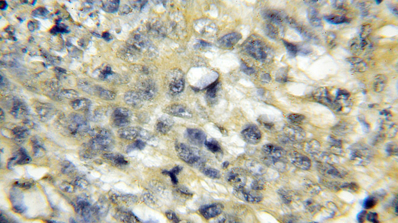 Immunohistochemical of paraffin-embedded human lung cancer using Catalog No:115748(SFTPD antibody) at dilution of 1:50 (under 10x lens)