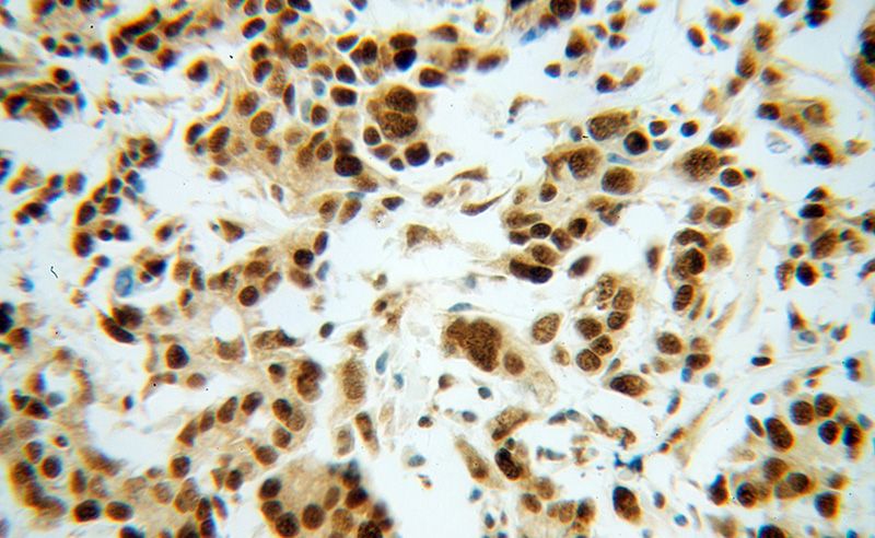 Immunohistochemical of paraffin-embedded human breast cancer using Catalog No:116466(BAT1 antibody) at dilution of 1:100 (under 40x lens)