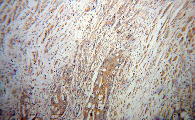 Immunohistochemical of paraffin-embedded human colon cancer using Catalog No:116546(UCP2 antibody) at dilution of 1:50 (under 10x lens)