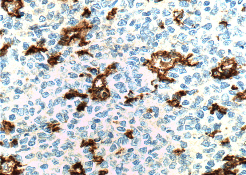 Immunohistochemistry of paraffin-embedded human tonsillitis tissue slide using Catalog No:107040(CD11c/Integrin alpha X Antibody) at dilution of 1:200 (under 40x lens). heat mediated antigen retrieved with Tris-EDTA buffer(pH9).