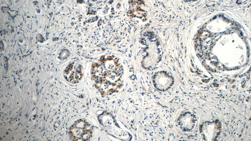 Immunohistochemistry of paraffin-embedded human pancreas cancer tissue slide using Catalog No:110388(LIMA1 Antibody) at dilution of 1:50 (under 10x lens)