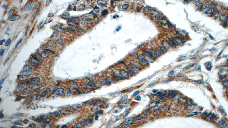 Immunohistochemistry of paraffin-embedded human colon cancer tissue slide using Catalog No:114524(RAF1 Antibody) at dilution of 1:50 (under 40x lens)