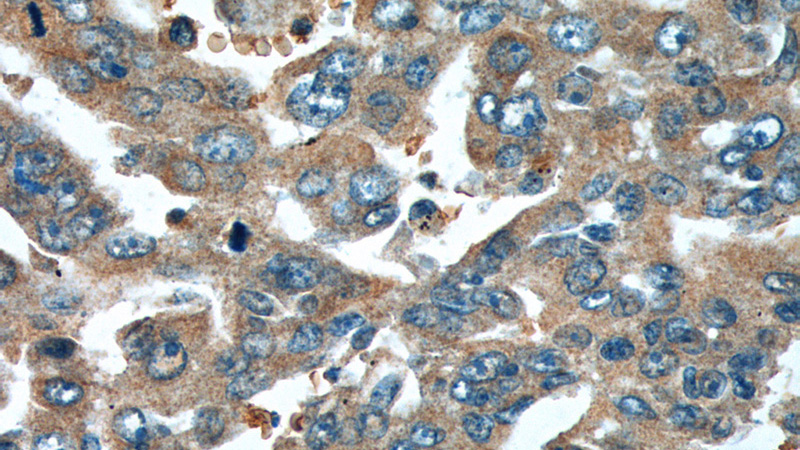 Immunohistochemistry of paraffin-embedded human lung cancer tissue slide using Catalog No:114923(RRM1 Antibody) at dilution of 1:200 (under 40x lens).