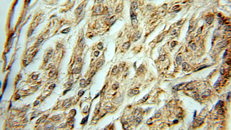 Immunohistochemical of paraffin-embedded human ovary tumor using Catalog No:107804(ABCE1 antibody) at dilution of 1:50 (under 10x lens)