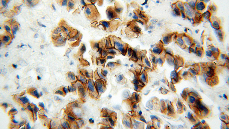 Immunohistochemical of paraffin-embedded human breast cancer using Catalog No:113619(CDH3 antibody) at dilution of 1:100 (under 40x lens)