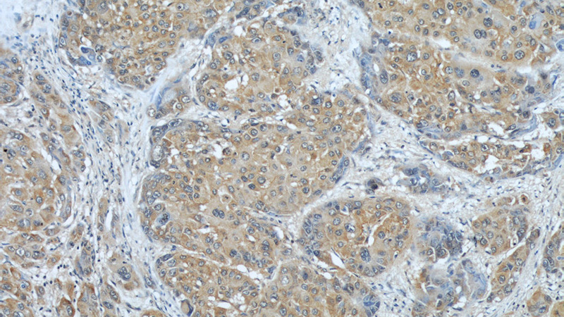 Immunohistochemical of paraffin-embedded human liver cancer using Catalog No:107856(AIP antibody) at dilution of 1:50 (under 10x lens)