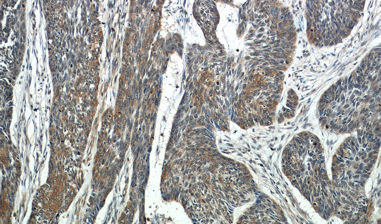 Immunohistochemistry of paraffin-embedded human skin cancer slide using Catalog No:107422(MLPH Antibody) at dilution of 1:50