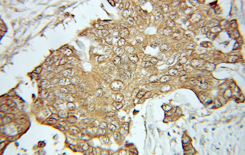 Immunohistochemical of paraffin-embedded human breast cancer using Catalog No:113293(NOL3 antibody) at dilution of 1:100 (under 40x lens)