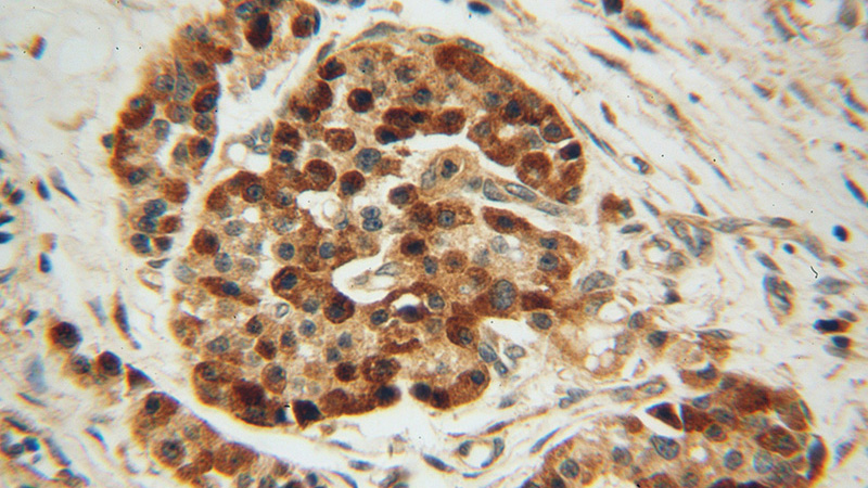 Immunohistochemical of paraffin-embedded human pancreas cancer using Catalog No:116902(ZADH2 antibody) at dilution of 1:50 (under 40x lens)