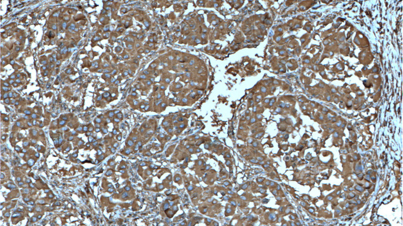Immunohistochemistry of paraffin-embedded human liver cancer tissue slide using Catalog No:107242(DSE Antibody) at dilution of 1:200 (under 10x lens). heat mediated antigen retrieved with Tris-EDTA buffer(pH9).