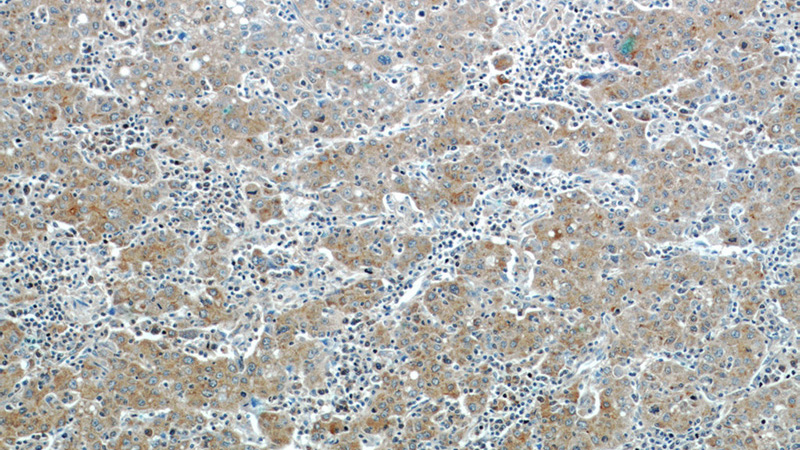 Immunohistochemistry of paraffin-embedded human liver cancer tissue slide using Catalog No:111088(GPC3 Antibody) at dilution of 1:50 (under 10x lens)