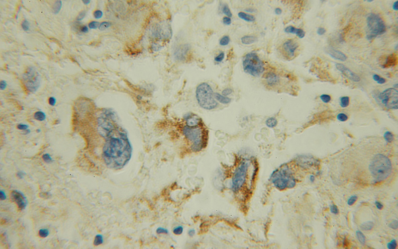 Immunohistochemical of paraffin-embedded human gliomas using Catalog No:112470(MAOB antibody) at dilution of 1:100 (under 10x lens)